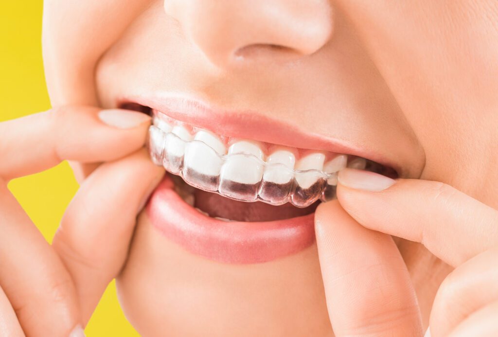 Smile - Fit for Zahn - Zahnarztpraxis Erlangen, Dr. Lösch, Dr. Engelhardt, Bleaching für ein natürlich weißes Lächeln, Veneers, Zahnschienen